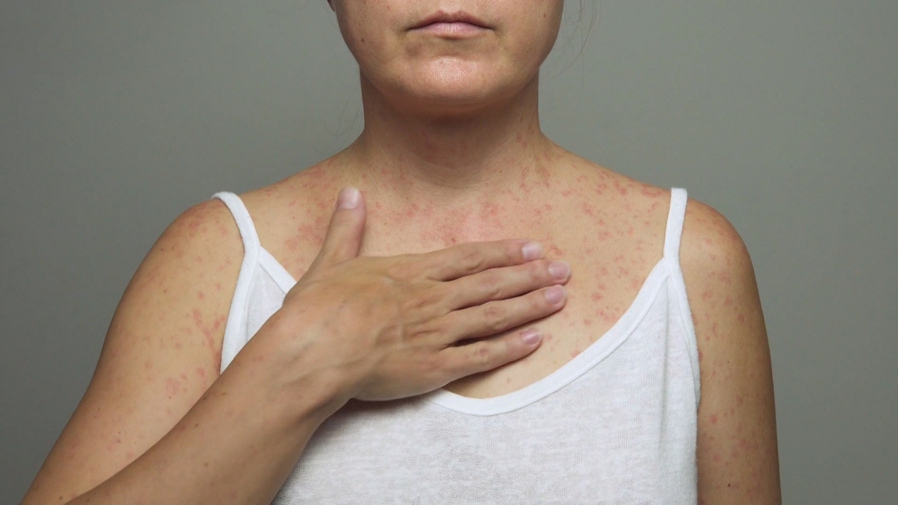 T6/E26: Vuelve el sarampión