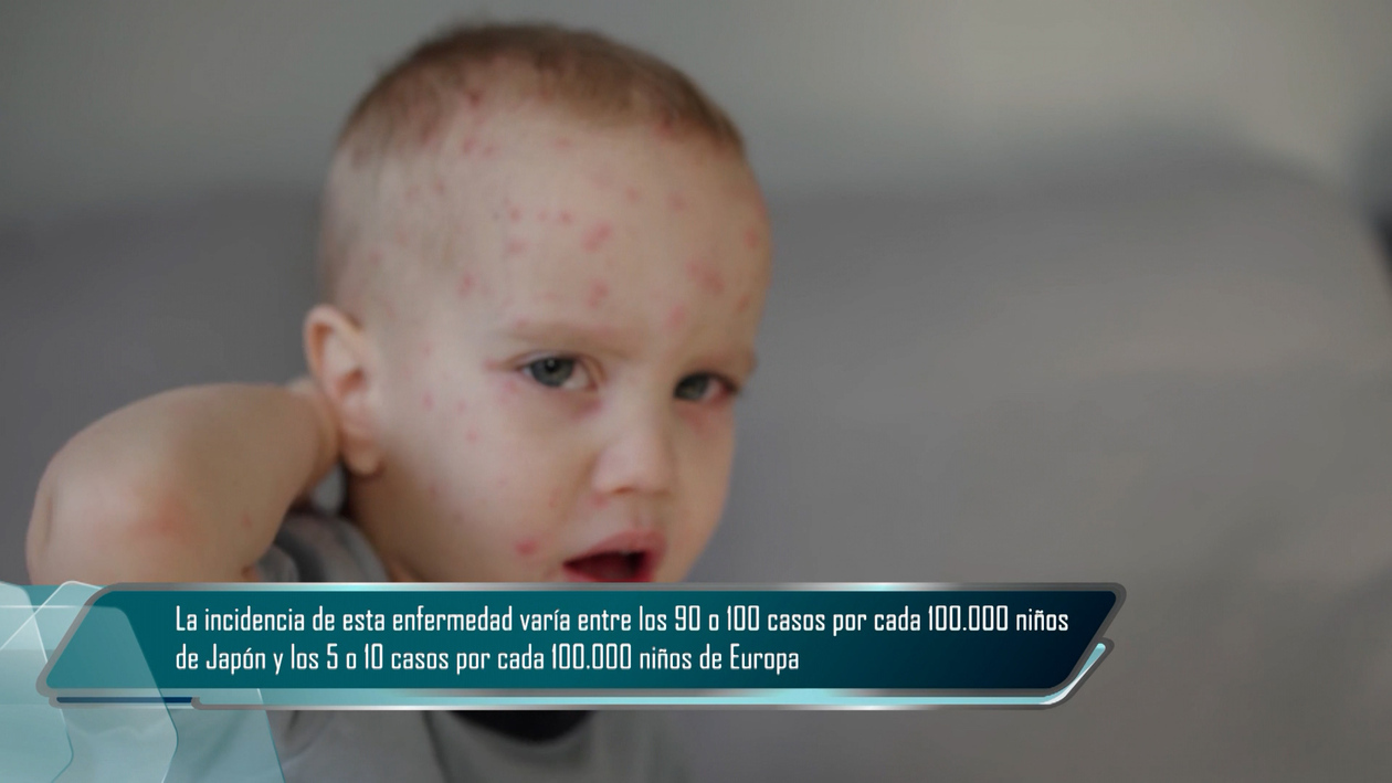 T6/E20: Enfermedad de Kawasaky