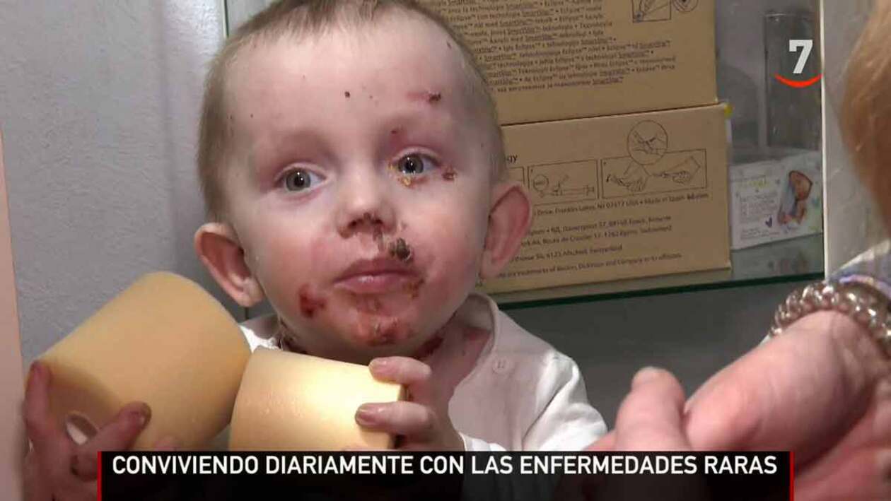 150.000 personas conviven con una enfermedad rara en Castilla y León